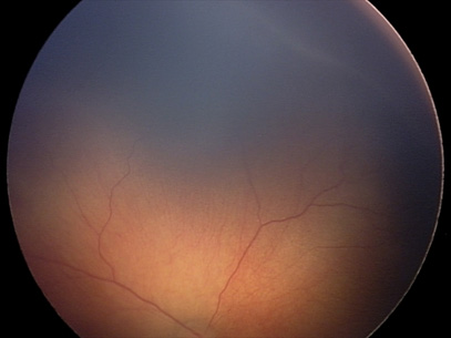 1 стадия ретинопатии недоношенных