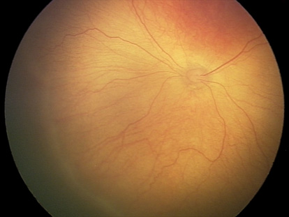 2 стадия ретинопатии недоношенных