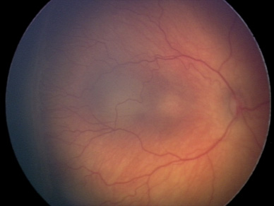 Пороговая стадия ретинопатии недоношенных