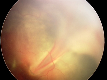 Отслойка сетчатки у ребенка с ретинопатией недоношенных