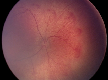 Задняя агрессивная ретинопатии недоношенных
